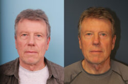 before and after blepharoplasty