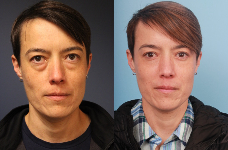 before_after_img