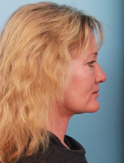 after facelift