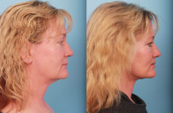 before and after facelift