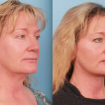 facelift-merged-2
