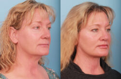before and after facelift