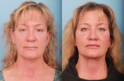 before and after facelift