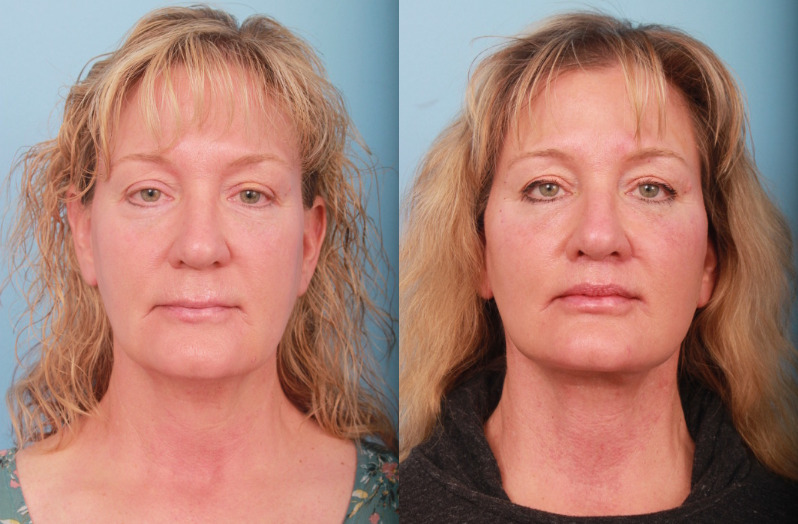 before_after_img