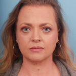 liposuction-after