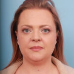 liposuction-before