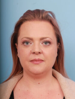 before liposuction