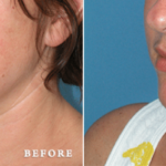 liposuction-merged