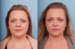 before and after liposuction