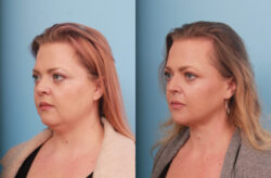 before and after liposuction