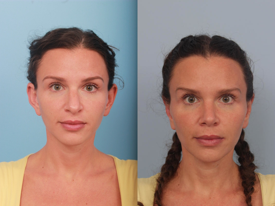 before_after_img