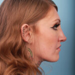 rhinoplasty-after-15