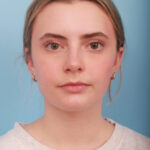 rhinoplasty-after