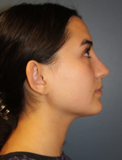 after rhinoplasty