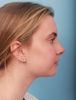 after rhinoplasty