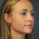 rhinoplasty-after-4