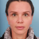 rhinoplasty-after-8