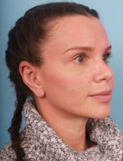 after rhinoplasty