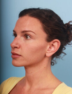 before rhinoplasty