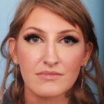 rhinoplasty-before-12