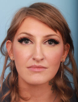 before rhinoplasty