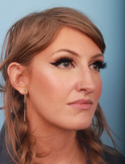 before rhinoplasty
