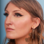 rhinoplasty-before-14