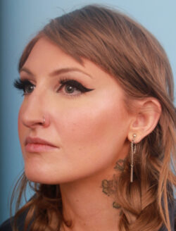 before rhinoplasty
