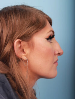 before rhinoplasty