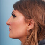 rhinoplasty-before-16