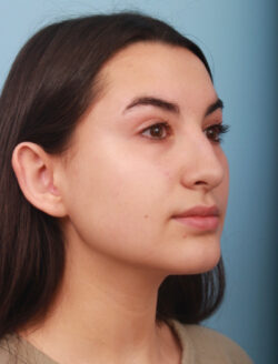 before rhinoplasty