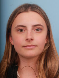 before rhinoplasty