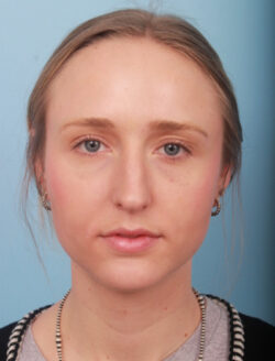 before rhinoplasty