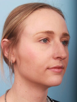 before rhinoplasty