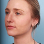 rhinoplasty-before-5