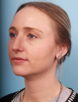 before rhinoplasty