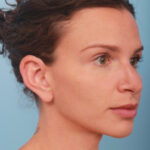 rhinoplasty-before-9