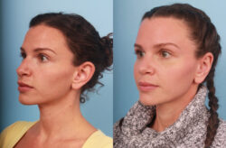 before and after rhinoplasty