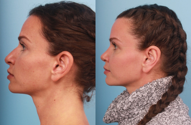 before_after_img