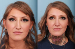before and after rhinoplasty