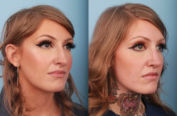 before and after rhinoplasty