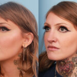 rhinoplasty-merged-14