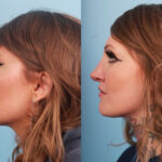 rhinoplasty-merged-16