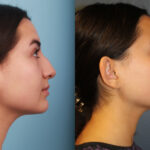 rhinoplasty-merged-19
