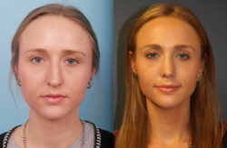 before and after rhinoplasty