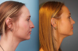 before and after rhinoplasty