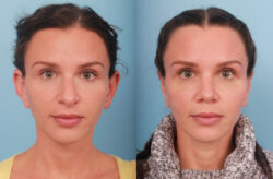 before and after rhinoplasty