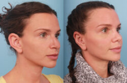before and after rhinoplasty