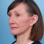 lower-facelift-after-2