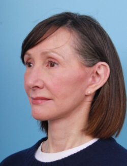 after lower facelift